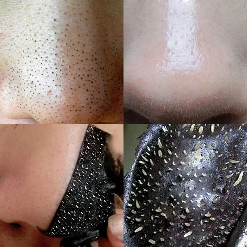 Close-up of pore strips removing blackheads and impurities from the skin.
